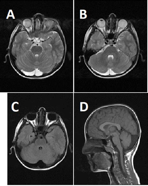 mega cisterna magna versus arachnoid cyst|Mega cisterna magna .